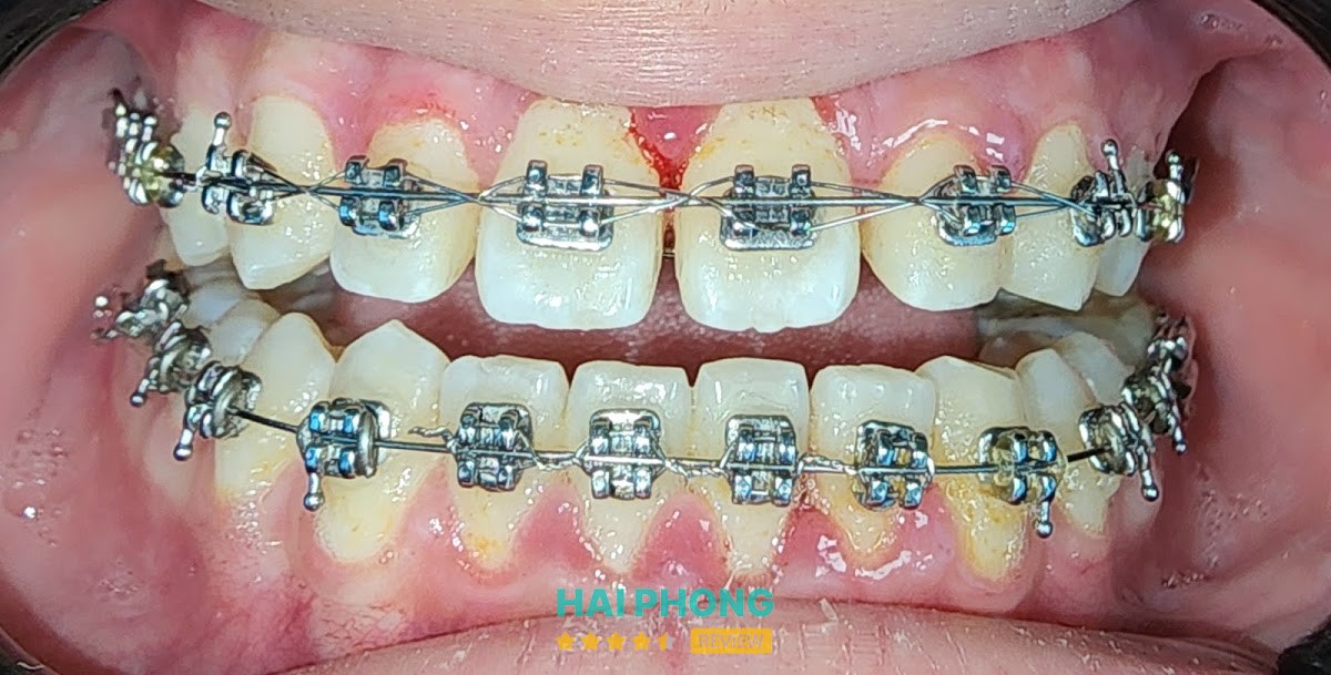 Nha Khoa Trồng Răng - Á CHÂU – hình ảnh 3