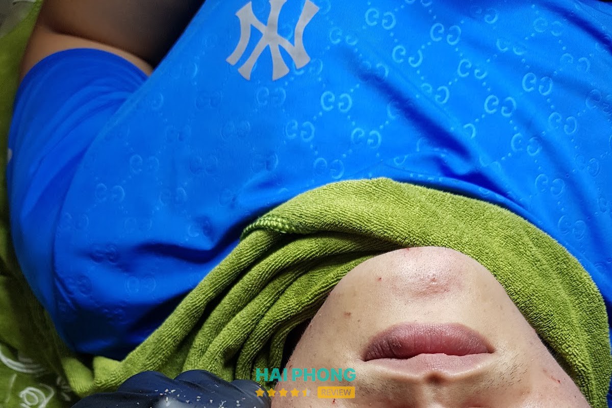 điều trị mụn hải phòng – hình ảnh 3